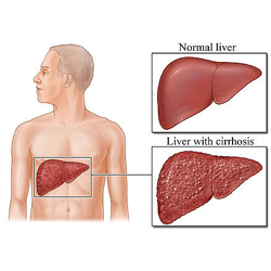 Disease of the Liver  -  